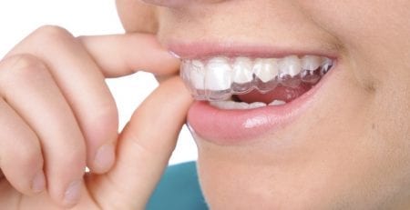 Cosmetic Teeth Straightening